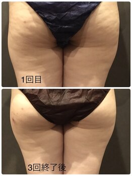 ビューティサロン ファイン(Fine)/30代/パイラソードでセル脂肪減