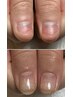 最短1ヶ月【自爪コンプレックス解消】深爪矯正★自爪育成で噛み癖なども解消