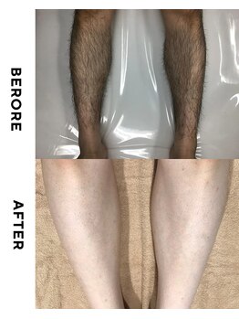 メロウ(mellow)/メンズ脚☆6回施術