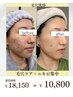 【毛穴ケア×ニキビ集中エステ】毛穴洗浄￥18,150→￥10,800