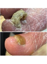 チェンジ(CHANGE)/変形爪