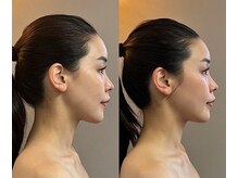 リフテグレース(LIFTE Grace)/オールハンド小顔フェイシャル