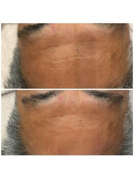 ビュウナ 銀座(BEAUNA)/アルティメットパルス