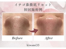 キワミ サーティスリー(kiwami33)/イチゴ鼻にお悩みの方におすすめ