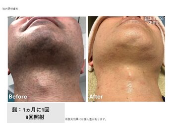 サロン アンネ(Anne)/高松市メンズ脱毛