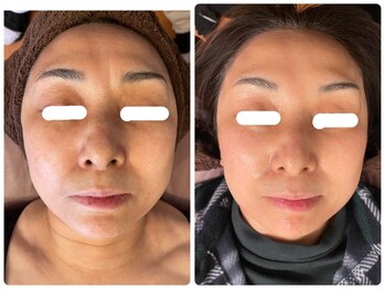 ハーブピーリング 恵比寿/施術回数3回 ハーブピーリング