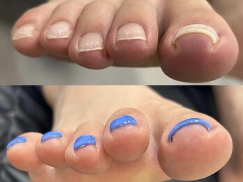バレンタイン(Valentine)の写真/足元のお悩み、ご相談ください♪羽のようにかるいつけ心地の巻き爪がケアできるジェル『ペディバランス』