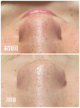 トータルビューティーサロン ヴィヴィエ(ViVier)/スッキリ毛穴ケア症例2回