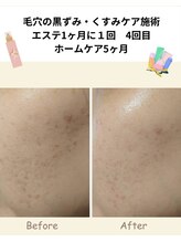 マインドール/泉大津エステ毛穴引締め美白ケア