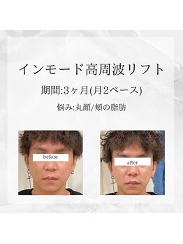 メディカルエステ 東銀座店/業界初インモード高周波リフト 