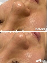 ビューティサロン アール(R)/たるみ毛穴改善