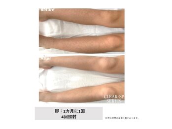 ハナフク(hanafuku)/before→after