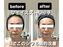 ミーナヴェル(Mi-Nabelle)/おでこのしわ改善