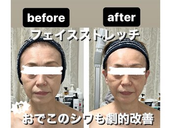 ミーナヴェル(Mi-Nabelle)/おでこのしわ改善