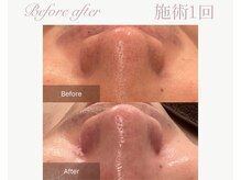 パルタージュ(Partage)/毛穴／黒ずみケア