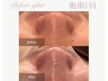 パルタージュ(Partage)/毛穴／黒ずみケア