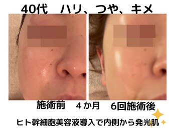 エンジェルエッグ/◆ヒト幹細胞美容液の効果