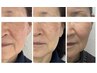 【3名様】70代でもしみ取れた!プラズマ幹細胞贅沢1mlフェイシャル初回45000→