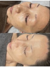 レクシア(LEXIA)/肌質改善症例｜ハリ艶