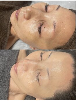 レクシア(LEXIA)/肌質改善症例｜ハリ艶