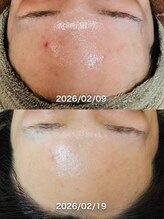 ルーク(Luke)/ニキビケア／くすみ／毛穴