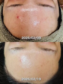 ルーク(Luke)/ニキビケア／くすみ／毛穴