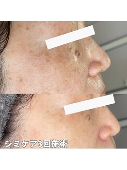 マール(MARL.)/シミケアbefore/after