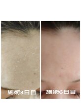 エタニティ 西宮店(Eternity)/韓国ハーブピーリング