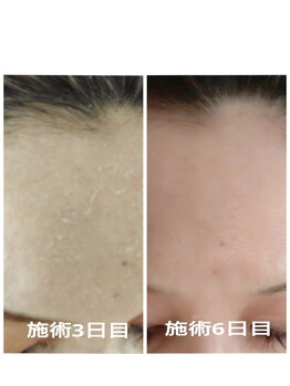 エタニティ 西宮店(Eternity)/韓国ハーブピーリング