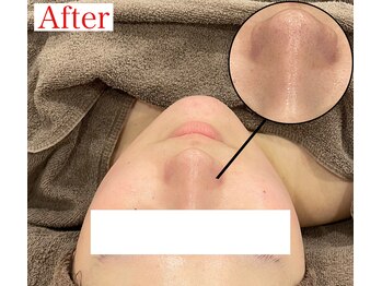 ビーブルーセブン(B.BLUE7)/【最新毛穴洗浄★After】