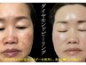 【美肌】ダイヤモンドピーリング☆ホ-ムケア＆アフタ-エステ付き☆通常45,000