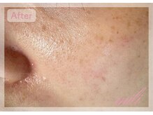 ミリ(mili)/頬の赤み・毛穴開きを改善