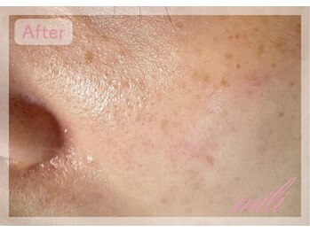 ミリ(mili)/頬の赤み・毛穴開きを改善