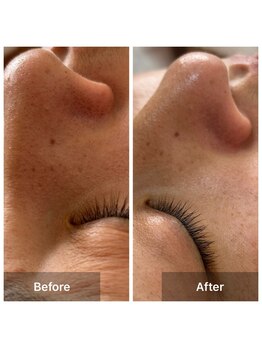 サロン ド アヤ(salon de Aya)/【毛穴洗浄】ただ一回だけの変化