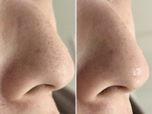 リッチ(Rich+)/毛穴の黒ずみ対策★