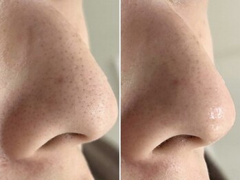 リッチ(Rich+)/毛穴の黒ずみ対策★