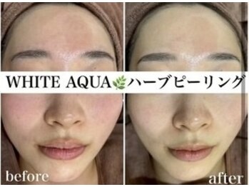 ホワイトアクア 四日市店(WHITE AQUA)/ハーブピーリング四日市毛穴改善