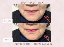 エステサロン プラスエー(+A)/コラーゲン部分導入　１回施術