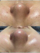 レクシア(LEXIA)/肌質改善症例 | 毛穴黒ずみ改善