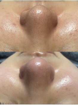 レクシア(LEXIA)/肌質改善症例 | 毛穴黒ずみ改善