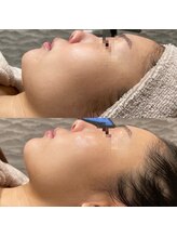 ビュウナ 銀座(BEAUNA)/マルチウェーブリフト