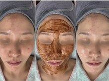 イーヴ(Eave)/【肌質改善】カカオピーリング