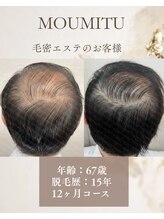 ボディデザインホームクレアフェリーチェ 神戸(Body design home Crea felice)/MOUMITUスカルプ/毛密エステ