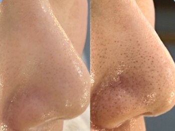 マリヴェリーテ(Mari verite)の写真/【毛穴/薬院】徹底毛穴ケア￥7500♪毛穴の黒ずみ/詰まり/ざらつき/開きのお悩みに◎毛穴洗浄で汚れリセット!