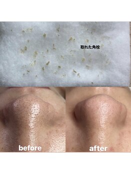 ビューティーネイル(Beauty Nail)/毛穴エクストラクション