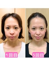 ソエルテ(soerute)/小顔筋膜リフト