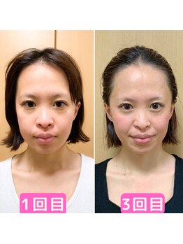 ソエルテ(soerute)/小顔筋膜リフト