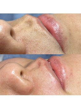 ネージュ(Neige)/口元スッキリ！