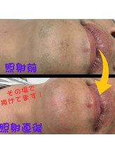 フェリッセ(FELISSE)/ヒゲ　照射前と照射直後の違い