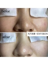 ヴィディトゥ(vidyto)/人気毛穴改善コース＋エンビロン